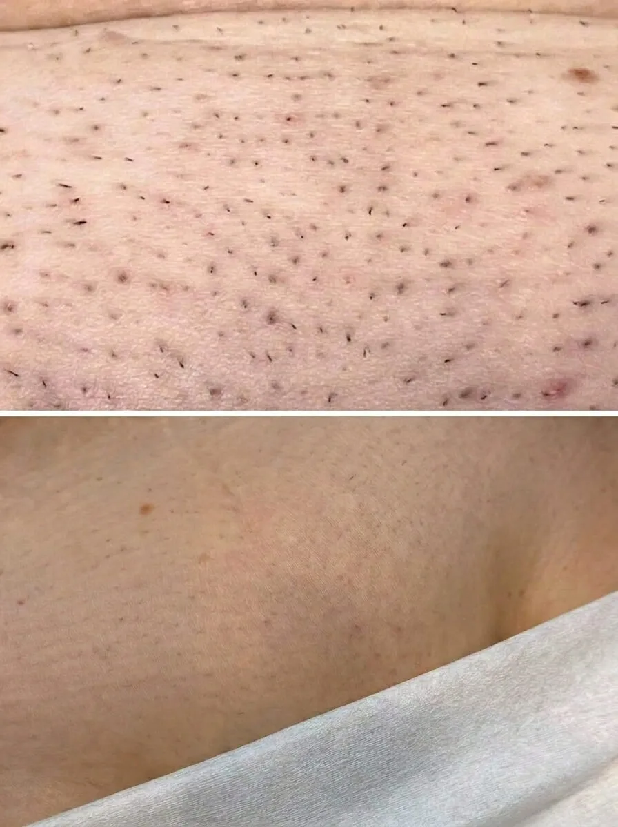 Resultaat laserontharing: dunnere haartjes