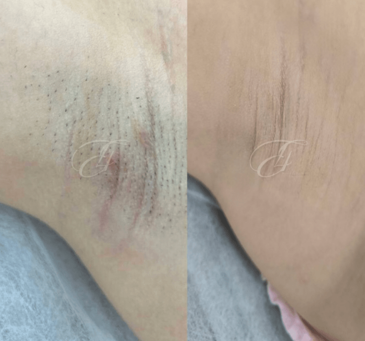 Resultaat laserontharing: gladde huid
